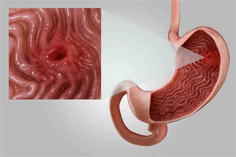 What Is A Stomach Ulcer Here S What You Need To Know About Symptoms And Treatment Global
