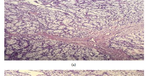 Cutaneous Metastasis Of Renal Cell Carcinoma A Case Report