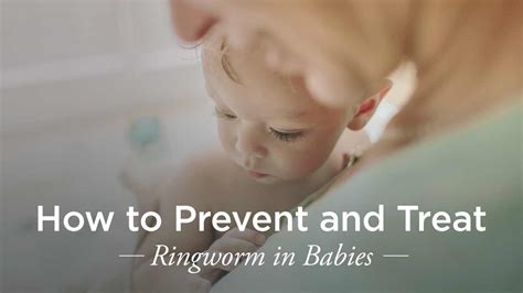 Ringworm In Babies Treatment And Prevention