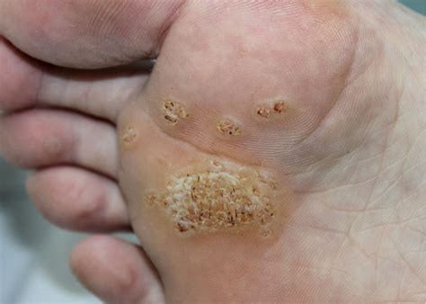 Verruca Needling Treatment Verrucae And Wart Removal Somerset