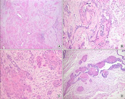 A Extensive Squamous Metaplasia Showing Large Sheet Isolated Nest Or Download Scientific