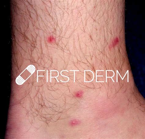 It is hard to say what the white bumps are without seeing them. Itchy Red Bumps on Skin - Potential Causes