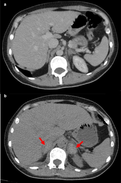 A Initial Axial Unenhanced Ct Scan Of The Abdomen On Day Of Admission