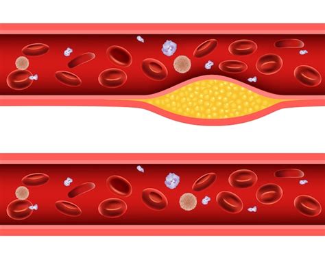 Premium Vector Illustration Of Artery Blocked With Bad Cholesterol