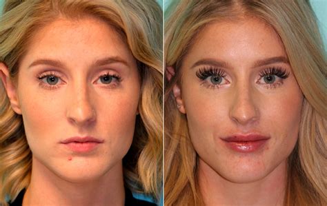 Lip Augmentation Photos Chevy Chase MD Patient