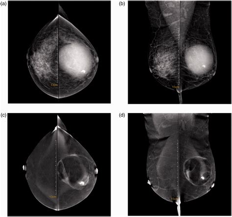 Giant Epidermal Inclusion Cyst With Infection Arising Within The Breast