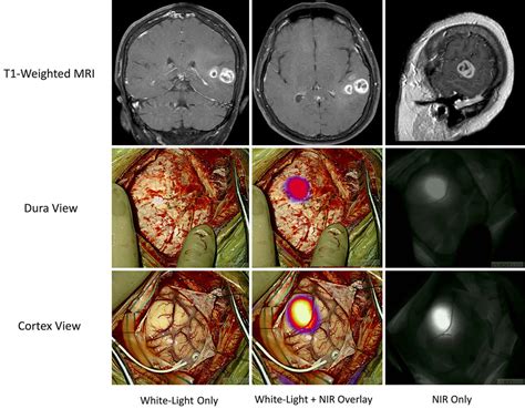 Applications Of Indocyanine Green In Brain Tumor Surgery Review Of