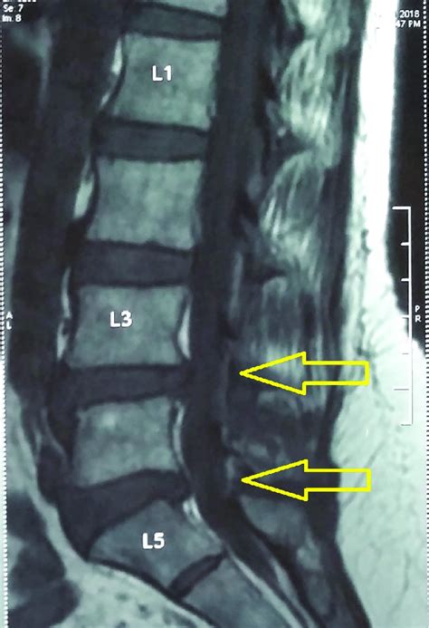 Mri Spine Showing Disc Bulge At L3 L4 And L4 L5 Levels With The