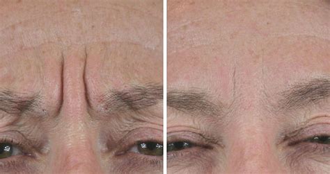 There is no loss of sensory feeling at all during the. Frown Line Removal | Soften and Smooth frown lines with ...