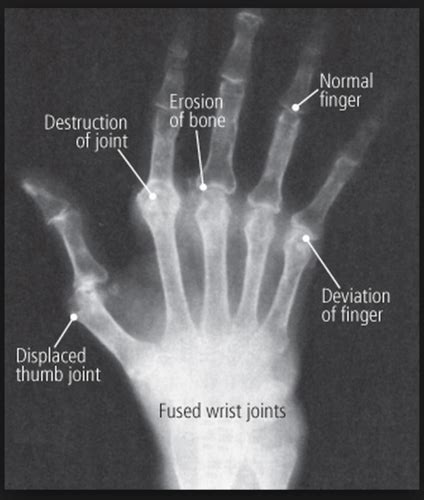 Rheumatoid Arthritis X Ray