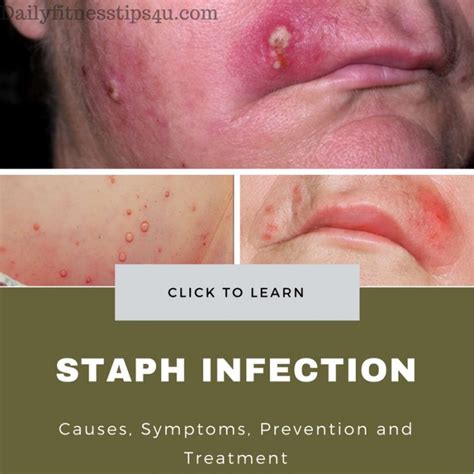Staph Infection Causes Symptoms Prevention And Treatment