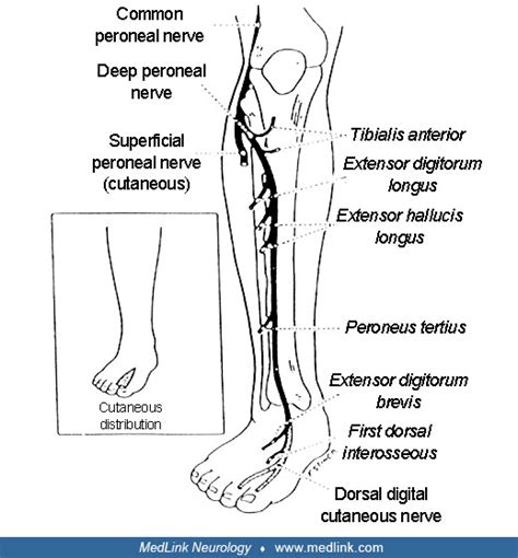 Peroneal Neuropathy Medlink Neurology