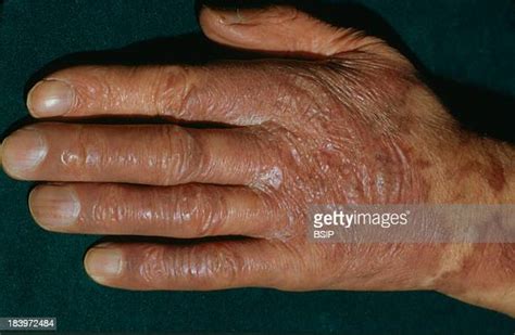 Kaposis Sarcoma Photos And Premium High Res Pictures Getty Images