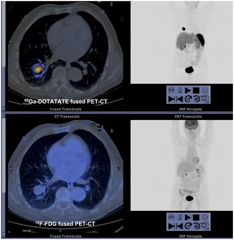 A Comparison Of 68ga Dotatate And 18f Fdg Petct In Pulmonary