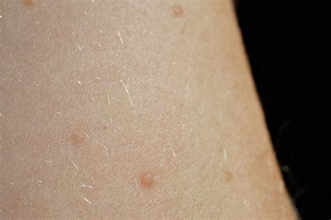 Cluster Of Blister Like Bumps At Skin Cancer Forum With Image Embedded Topic