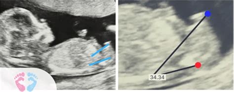 Understanding Nub Theory Ultrasound Images Baby Gender Pros