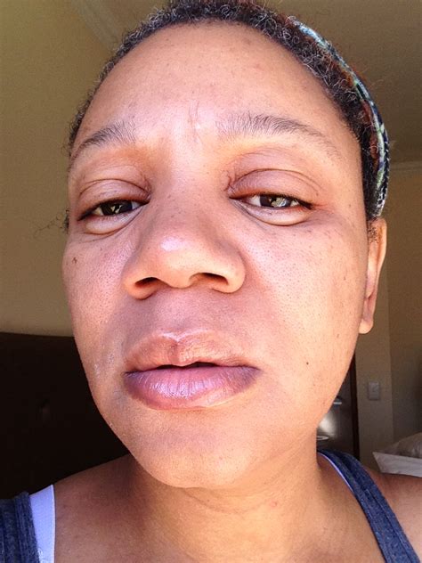 Allergic Reaction To Makeup Swollen Eyes Mugeek Vidalondon