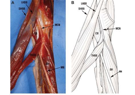 The Third Head Of The Biceps Brachii The Distal Part Of The Biceps
