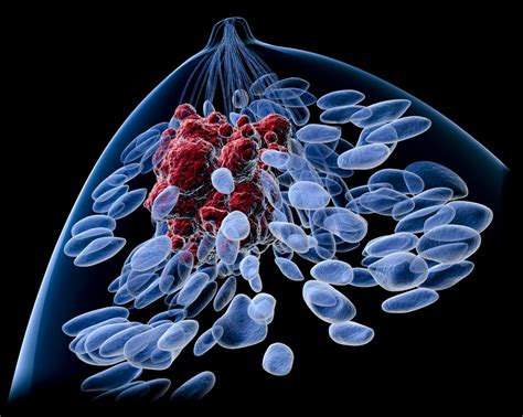 I Spy Trial Reveals New Breast Cancer Subtypes Inside Precision