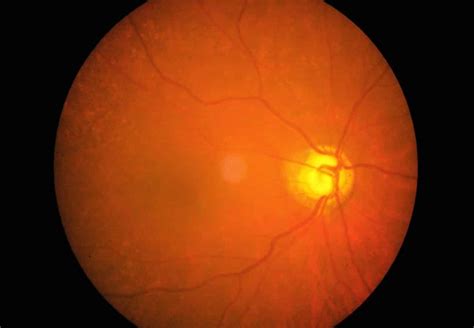 Types Of Glaucoma And How To Treat Them Área Oftalmológica Avanzada