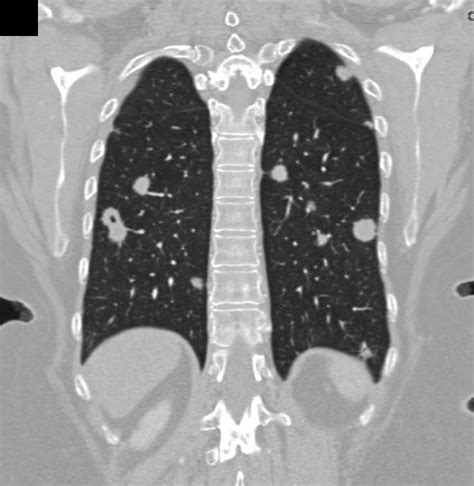 Metastatic Renal Cell Carcinoma To The Lungs Chest Case Studies