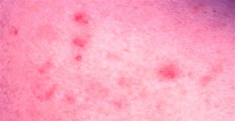 Maculopapular Rash Pictures Causes Symptoms Treatment