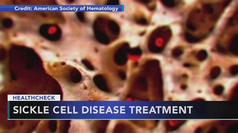 Fda Approves First New Drug In 20 Years For Sickle Cell 6abc Philadelphia