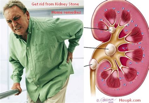 5 Ways To Cure Kidney Disease Naturally Howpk