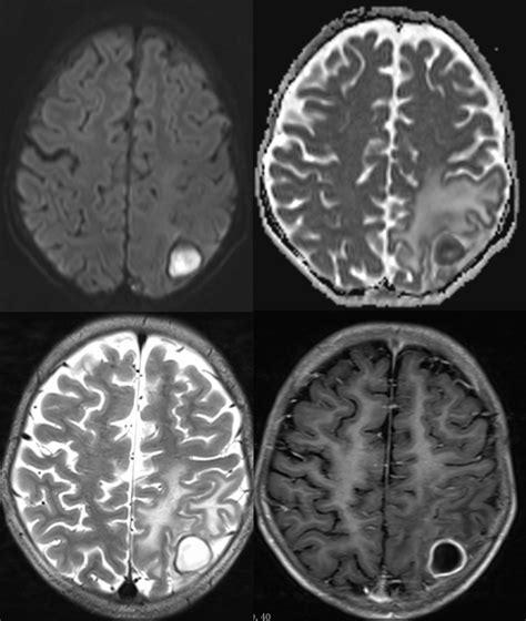 Brain Abscessbacterial Axial Dwiadc T2w Post Contrast T1w Images