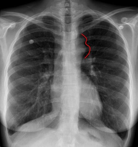 Coarctation Of The Aorta Radiology Case