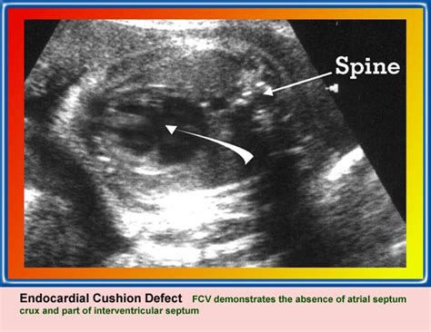 Atrioventricular Septal Defect Ultrasound