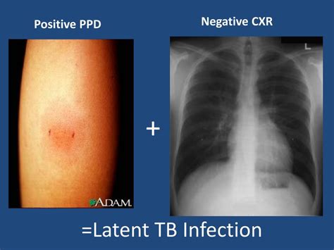 Ppt Pediatric Tuberculosis Nd Doh Hivstdtb Hepatitis Forum