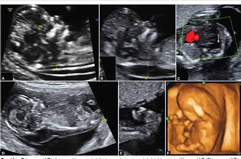 Challenges In Sonographic Detection Of Fetal Major Structural