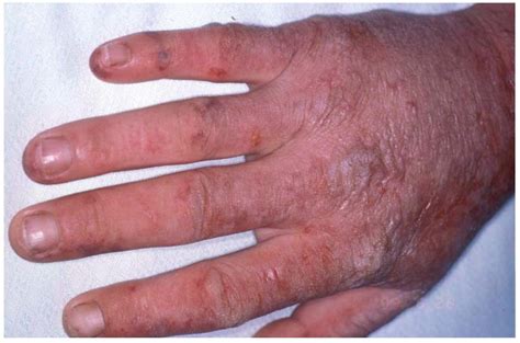 Porphyria Cutanea Tarda Causes Symptoms And Diagnosis