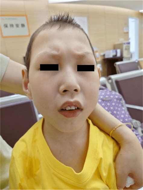 Facial Features Of The Patient Showing A Long Philtrum A Broad Nasal Download Scientific