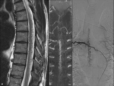 Advanced Magnetic Resonance Imaging Mri Techniques Of The Spine And