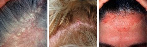 Does Seborrheic Dermatitis Cause Hair Loss Wimpole Clinic