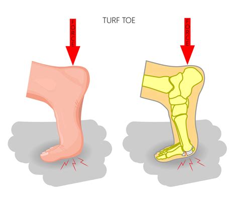 Turf Toe Causes And Symptoms My Footdr