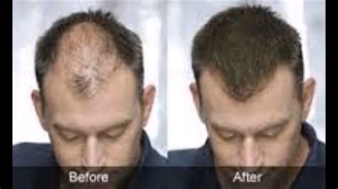 Seborrheic Dermatitis Hair Loss Before And After Seborrheic Dermatitis