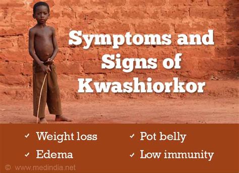 Kwashiorkor can be prevented by simply making sure that your child is fed with foods that contain enough amounts of protein. Kwashiorkor | Protein Malnutrition - Causes, Symptoms ...