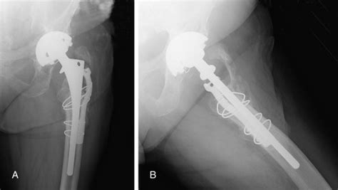 Treatment Of Symptomatic Greater Trochanteric Fracture After Total Hip