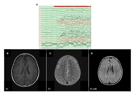 Figure Electroencephalography Eeg And Cranial Magnetic Resonance Download Scientific Diagram