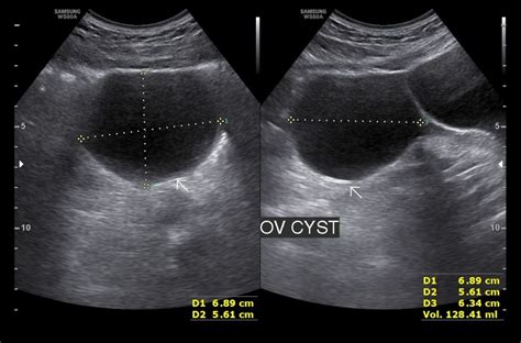 Benign Ovarian Cystic Mass Lesions Sono Scan 5d