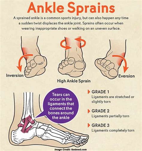 A Guide On Ankle Sprain Causessymptoms And More First Aid Tips