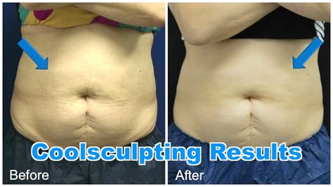 Coolsculpting Fat Freeze Before And After Youtube