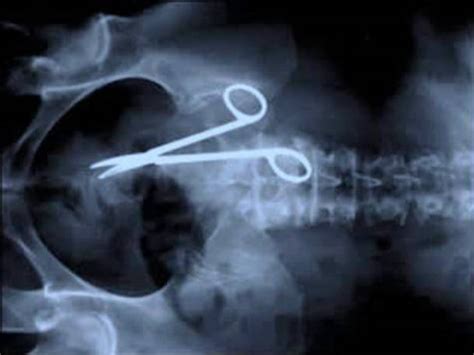24 Craziest Things That Ever Got Stuck In The Human Body Surgical Scissors In Abdomen X Ray