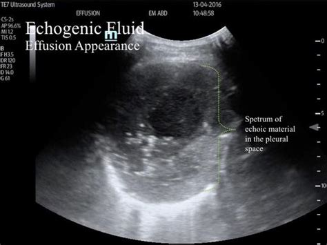 When you angle your probe perpendicular to the pleura, ultrasound waves reflect off the air from the pleura and the probe surface loculated (or septated) pleural effusions are most often seen in exudative effusions and. Internal Medicine Point of Care Ultrasound - IMPoCUS