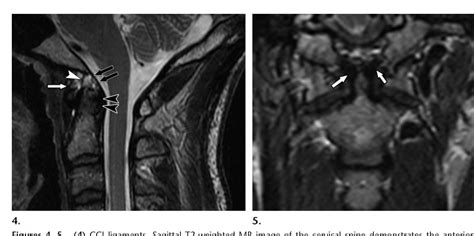 Figure 4 From Imaging Of Atlanto Occipital And Atlantoaxial Traumatic