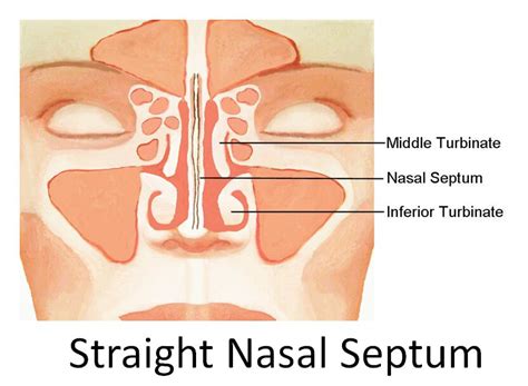 Nasal septal deviations play a critical role in nasal obstruction symptoms, aesthetic appearance of flow diagram for the literature search and overall study selection. Turbinate Hypertrophy - New York, NY Sinus Surgeon