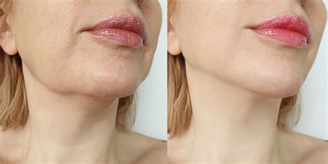 Profhilo London Before And After Price Hannah London Clinic